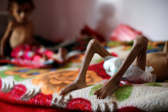 Podhranjeni otroci v bolnišnici v Sani. FOTO:&nbsp;Reuters
