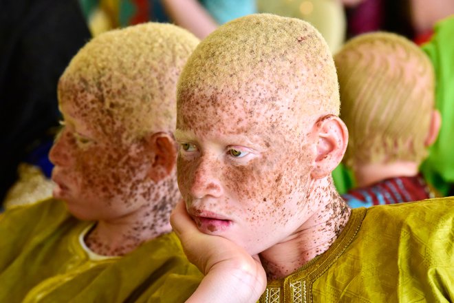 Portret senegalskega albino fanta v kulturnem centru Douta Seck v Dakarju ob mednarodnem dnevu ozaveščanja o albinizmu. Albinizem je dedno genetsko stanje, ki povzroči popolno odsotnost pigmentacije kože, las in oči. V nekaterih afriških državah so albini ugrabljeni, njihove dele teles pa še danes uporabljajo za čarobne napitke v prepričanju, da prinašajo bogastvo in srečo. FOTO: Seyllou/AFP
