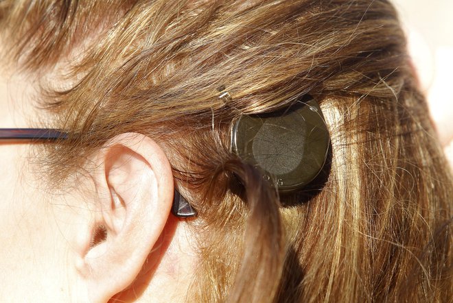 Polžev vsadek nadomesti okvarjene celice notranjega ušesa (polža) in zvok pretvarja v električne impulze ter ga prenese neposredno na slušni živec. FOTO: Mavric Pivk