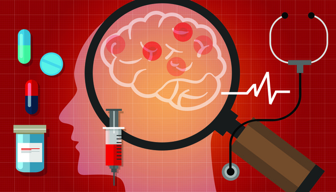 Pri alzheimerjevi bolezni se v možganih kopičita beljakovini amiloid beta in tau in povzročita spremenjeno delovanje možganskih procesov, nazadnje pa živčne celice, nevroni, propadejo. Foto Shutterstock