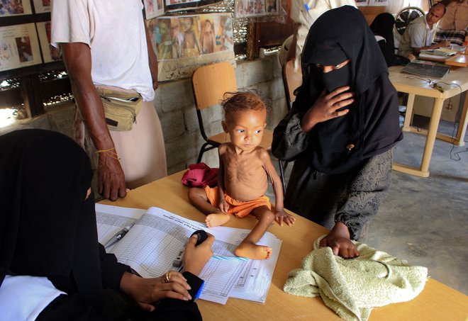 V Jemnu vlada epidemija lakote. FOTO: Esa Ahmed/AFP

