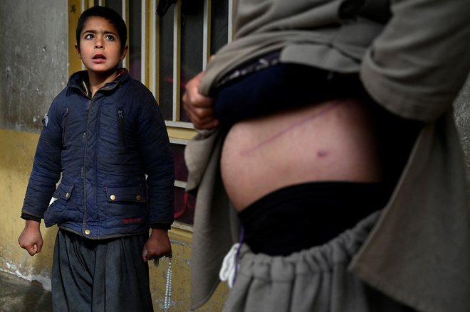 Nooruddin, ki je prodal svojo ledvico, da bi zbral denar za svojo družino, v svoji hiši v Heratu kaže brazgotine od operacije, medtem ko poleg njega stoji sin Javida. Brez zaposlitve, dolgov in s težavami, da bi nahranil svoje otroke, je Nooruddin menil, da nima druge izbire, kot da proda ledvico. Vse večje število Afganistancev je pripravljenih žrtvovati organ, da bi sploh lahko preživeli svoje družine. Foto: Wakil Kohsar/Afp

&nbsp;
