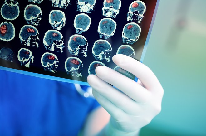 Z metodo diagnostike možganskih tumorjev na podlagi običajnih krvnih preiskav so odkrili tudi zelo majhne tumorje. FOTO:&nbsp;Shutterstock
