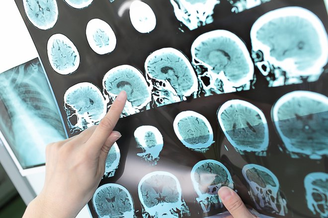 Svetovna zdravstvena organizacija poudarja, da je številna nevrološka stanja mogoče preprečiti. FOTO: Shutterstock
