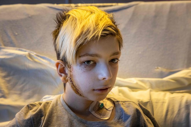 13-letni Volodimir po poškodbi sedi v bolniški postelji v Kijevu. Avto njegove družine je bil v Kijevu vključen v obstreljevanje med ruskimi in ukrajinskimi vojaki. Njegov oče je bil ubit, mati pa ranjena. Foto: Fadel Senna/Afp
