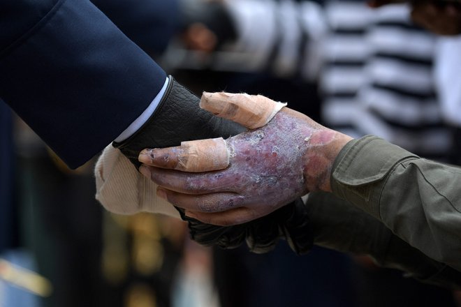 Yorman Cortes, kolumbijski policist za boj proti eksplozivnim sredstvom, ki je bil ranjen pred policijsko postajo v mestu Suarez, ko je skušal deaktivirati bombo, ki jo oblasti pripisujejo disidentom FARC, si med slovesnostjo ob dnevu herojev pri spomeniku padlim v boju v Bogoti poda roko s policistom. Foto: Raul Arboleda/Afp
