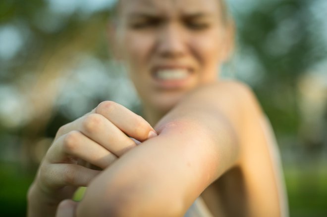 Znano je, da imajo ljudje, ki privabljajo komarje, na telesu določene vrste kislin, ki jih zdrave bakterije, živeče na koži, razjedajo in tako delno vplivajo na osebni vonj. FOTO: Arhiv Polet/Shutterstock
