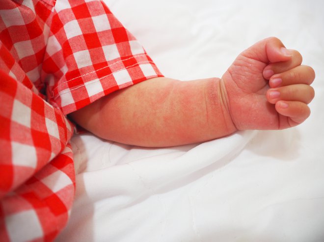 Atopijski dermatitis običajno nastopi pri trimesečnih dojenčkih. FOTO: Shutterstock
