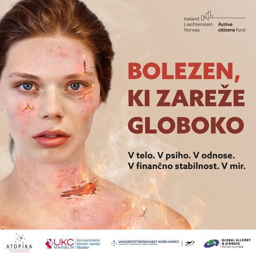 Plakati z obolelimi dekleti so del kampanje ozaveščanja o atopičnem dermatitisu. FOTO: Arhiv zavoda Atopica
