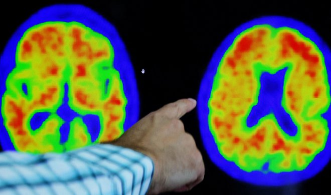 Možgani bolnika z Alzheimerjevo boleznijo. FOTO: Brian Snyder/Reuters