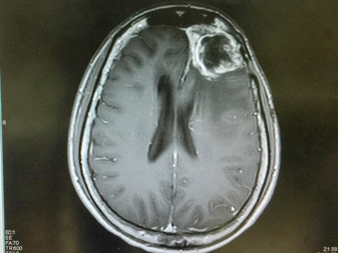 Obstaja več kot 100 vrst možganskih tumorjev. FOTO: Shutterstock

 