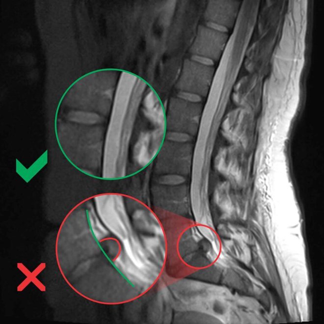 Herniacije FOTO: Sašo Jovanovič